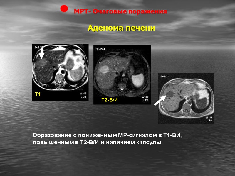 МРТ- Очаговые поражения   Аденома печени       